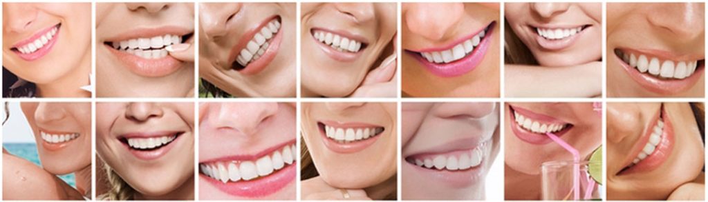 Megawhite Express Teeth Whitening - Smiles